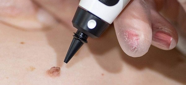 After Skin Tag Removal Wigston