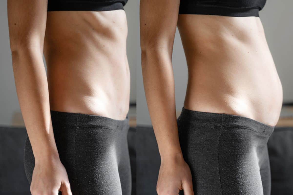 How long does diastasis recti take to improve Wigston?