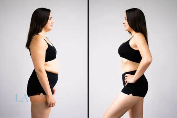 image of woman before and after results of LA-EMS Body Sculpting Wigston to help treat Diastasis recti